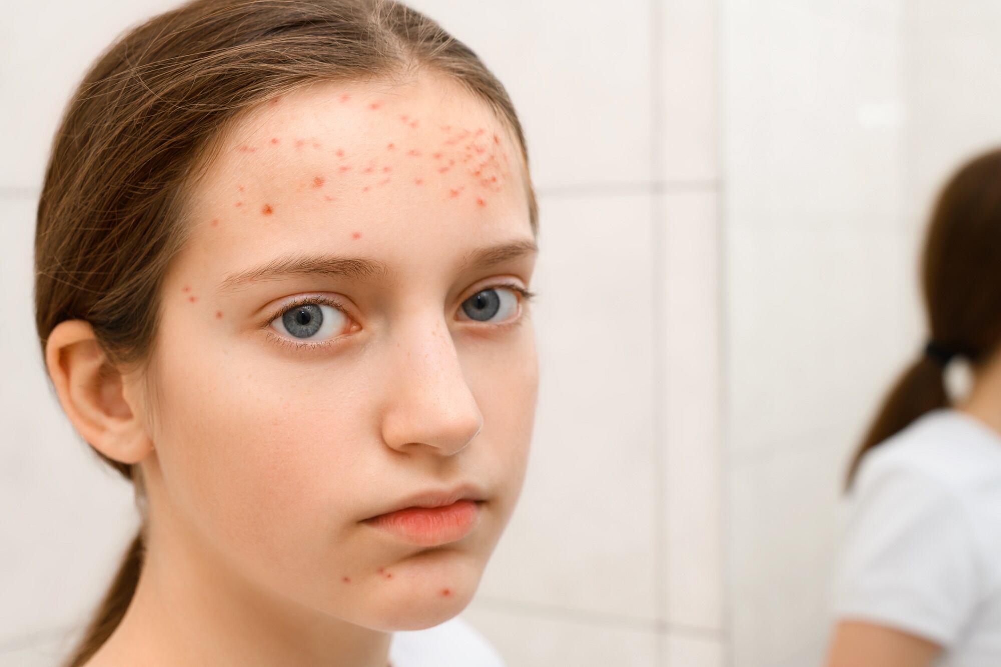 Parents-of-adolescents-say-acne-is-top-skin-concern-for-their-child-CeraVe-survey.jpg