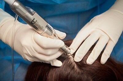Dr. Umar launches advanced hair transplant technology