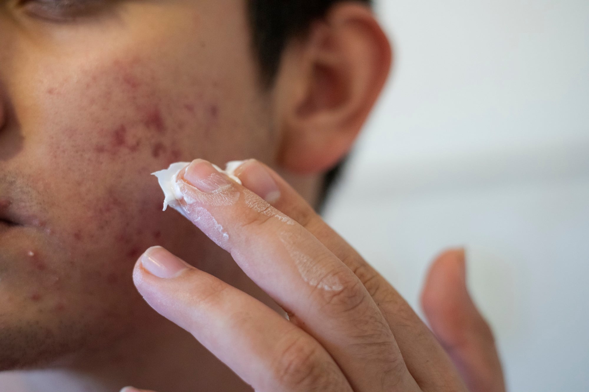 Analytical laboratory Valisure submits Citizen’s Application to FDA requesting ‘a recall and suspension of sale of products containing benzoyl peroxide’