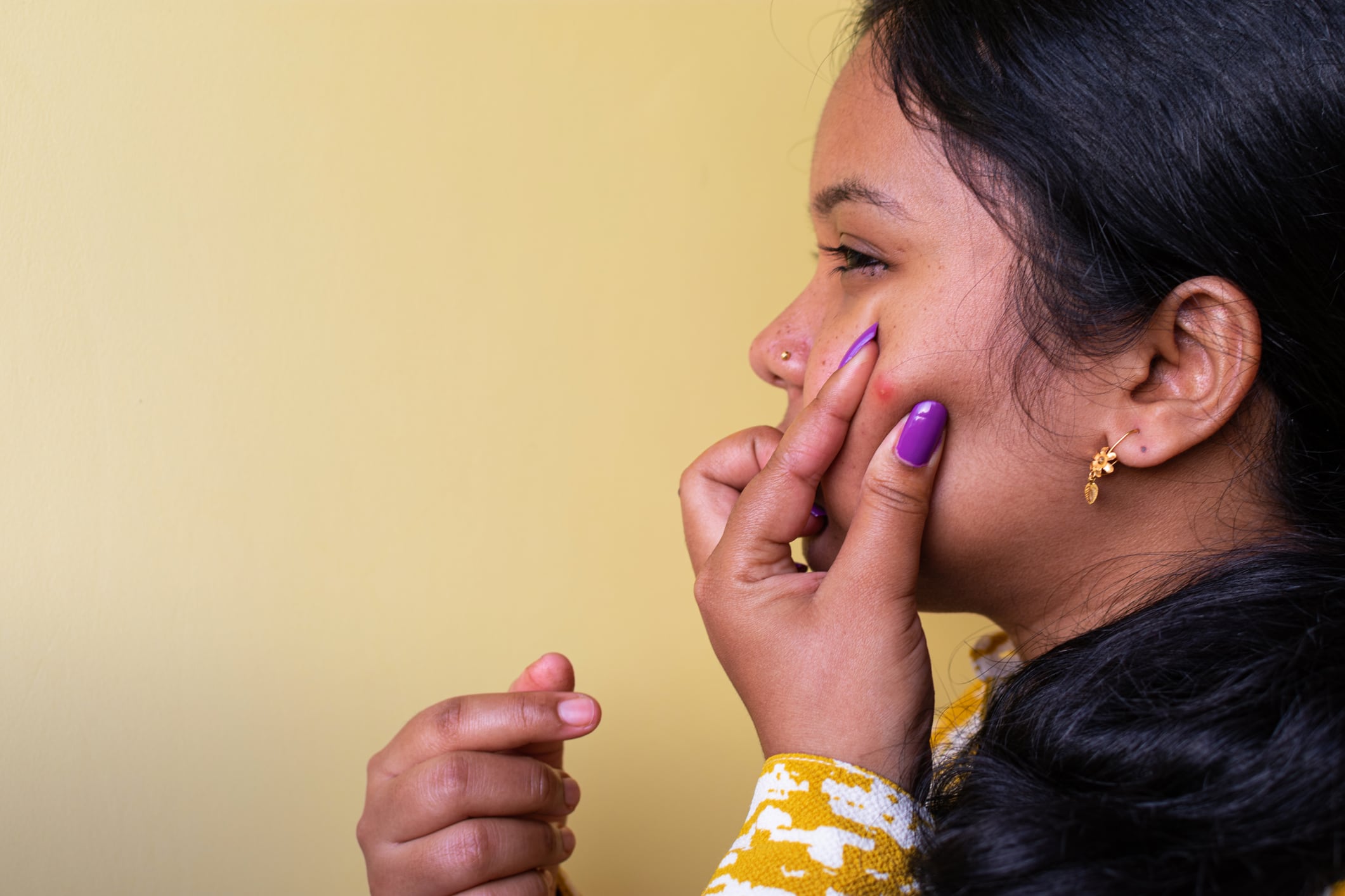 Adult-acne-study-Biochemical-and-hormonal-abnormalities-cause-adult-female-acne.jpg