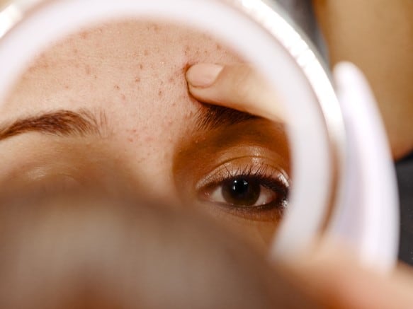 Phage ‘cocktail’ shows promise in targeting acne: Biocogent