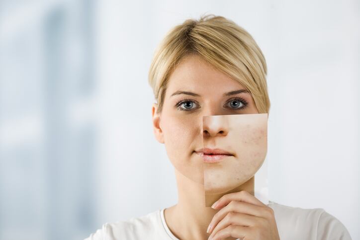3. Spot search: L’Oréal files patent for acne imaging tech