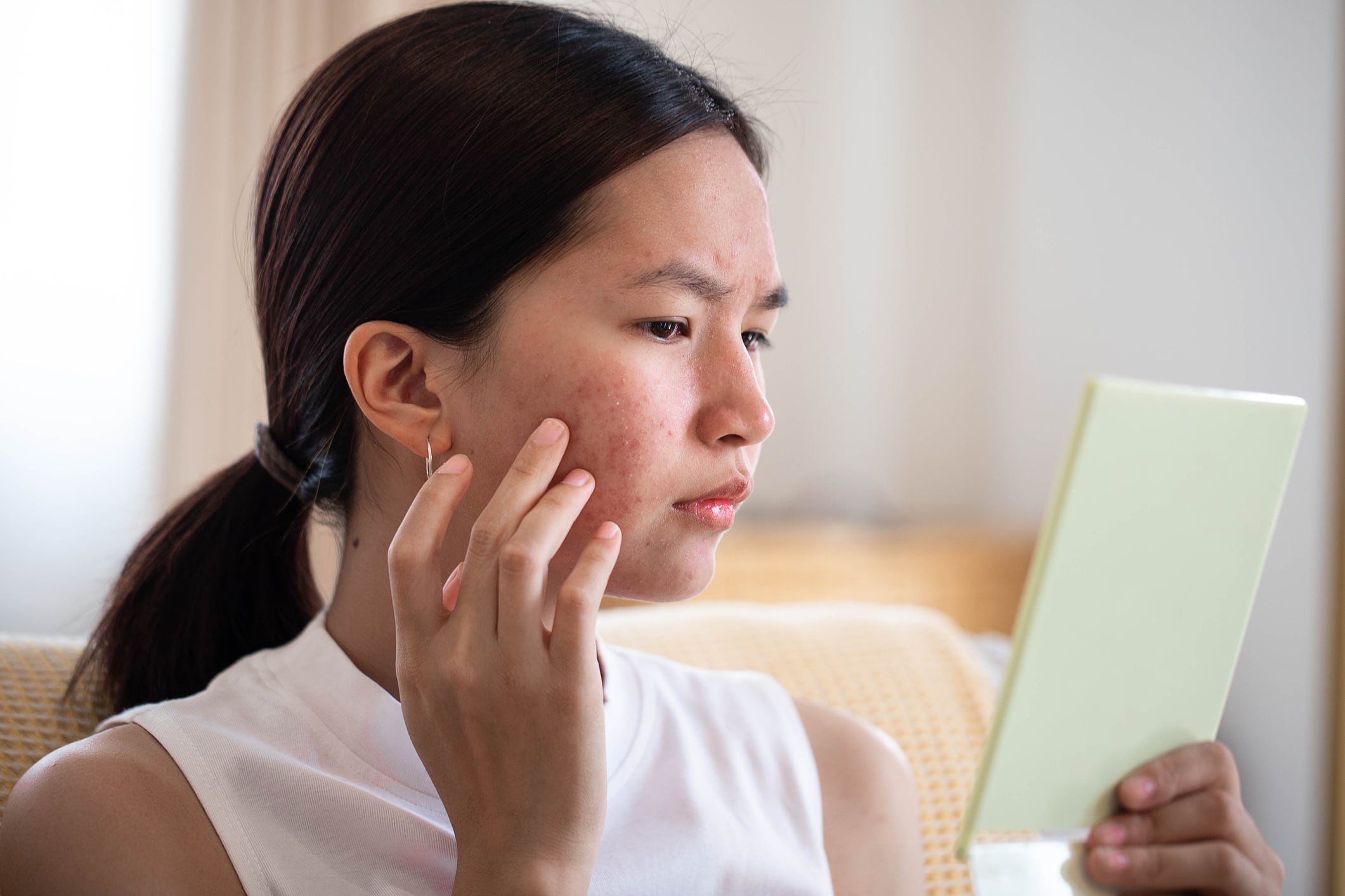 Acnocure could provide natural solution to acne, with antibiotic-level results: India, France study