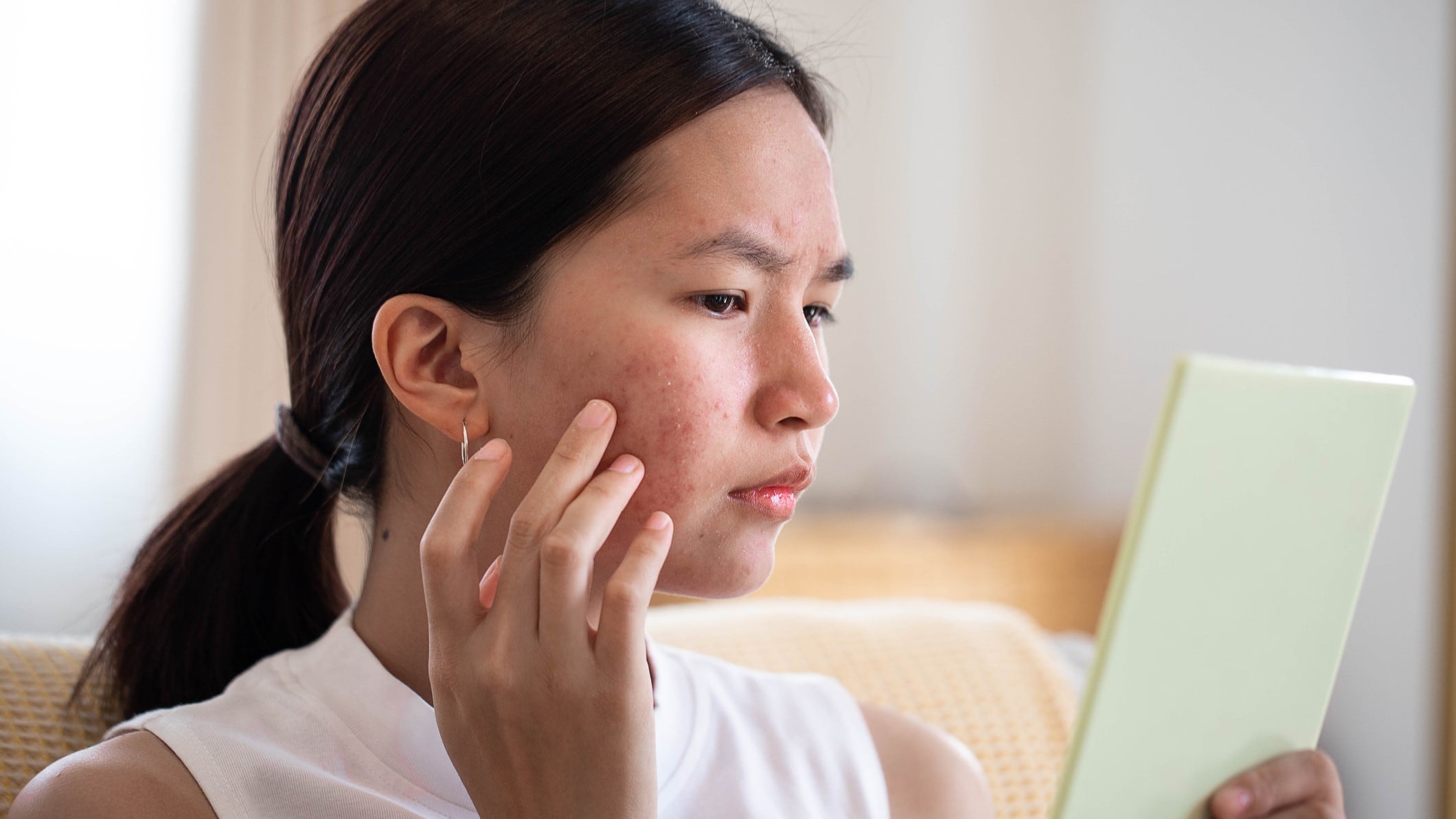 Atrophic scarring improves with adapalene and benzoyl peroxide use – Japan RCT