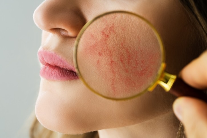 Skin redness or erythema is a common side effect of the skin condition rosacea (Image:Getty)