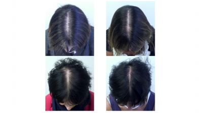Nutritional supplement shown to be effective in reducing female hair loss